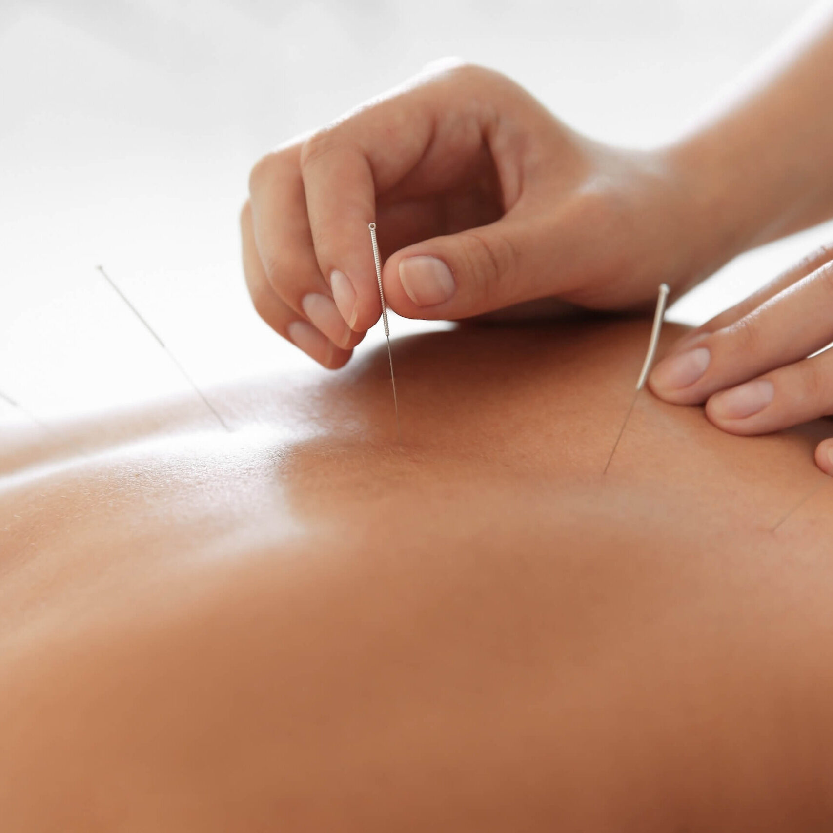 acupuncture treatment in Scottsdale.